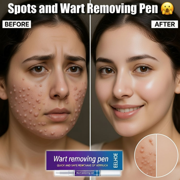 woman's face with acne using a wart removing pen, showing a clear skin improvement.